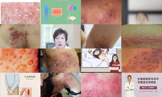 汕头生殖疱疹会传染家人吗