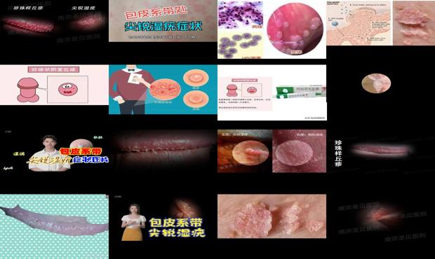 汕头包皮尖锐湿疣症状