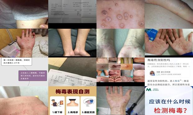 汕头怎么才知道自己中了梅毒