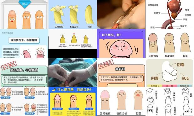汕头包皮是什么样的