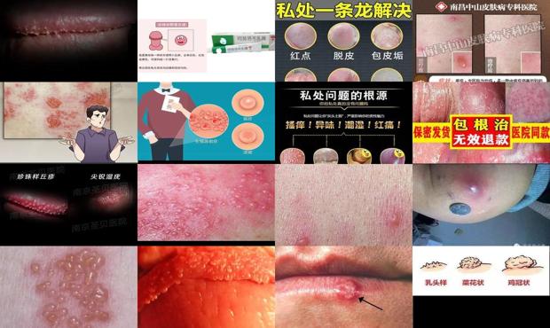 汕头龟头上长疱疹