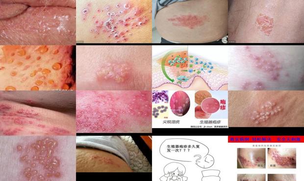 汕头生殖疱疹的症状和治疗