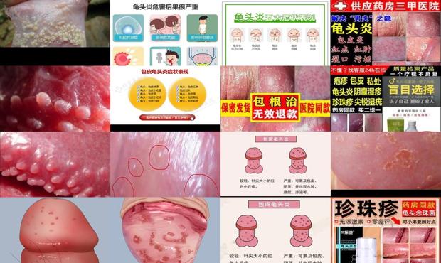 汕头男人龟头炎症