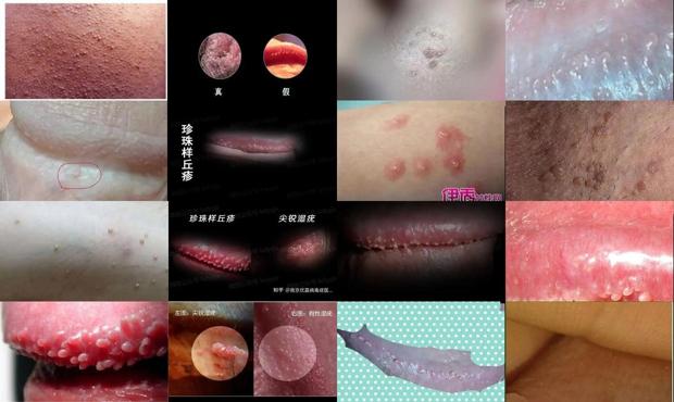 汕头男性尖锐初期小丘疹图片