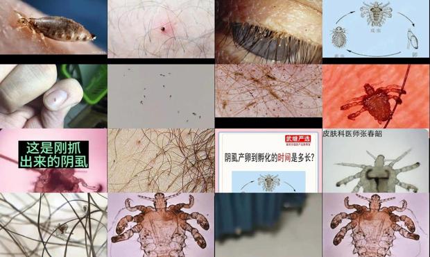 汕头阴虱抓干净了还会再长吗
