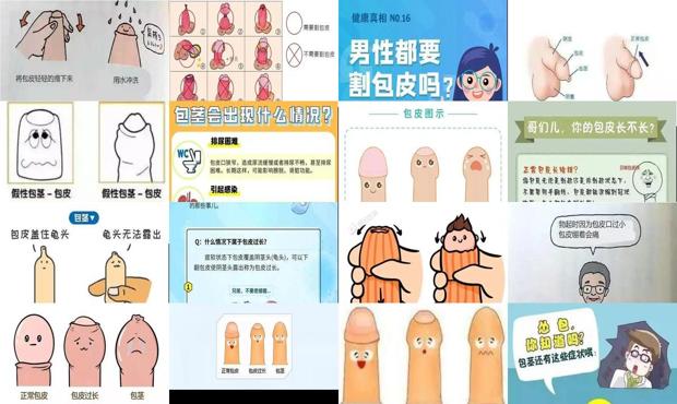 汕头*要割包皮吗