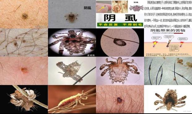 汕头什么是阴虱