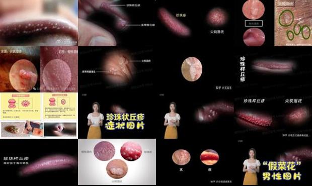 汕头男性珍珠疹与尖锐湿疣外观区别