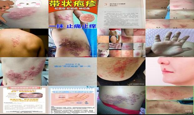 汕头疱疹怎么治疗