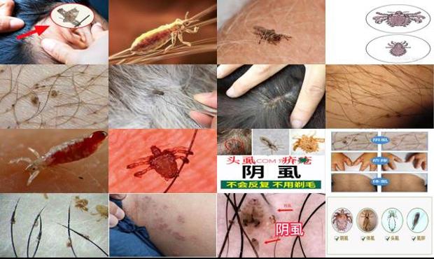 汕头虱子和阴虱一样吗