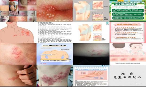汕头疱疹是怎么引起的