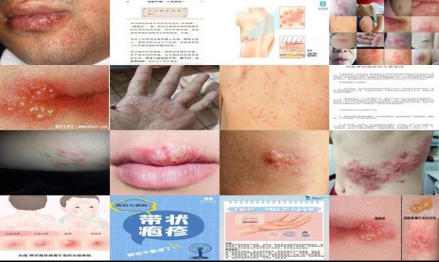 汕头疱疹怎么引起的