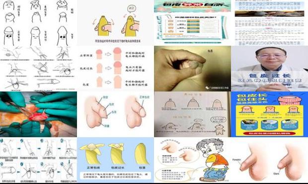 汕头包皮过长*要切么