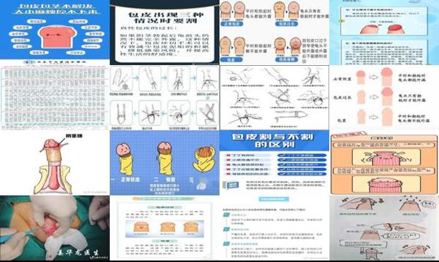 汕头男生为什么要割包皮