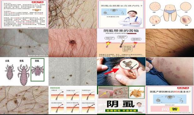 汕头阴虱子是怎么形成的