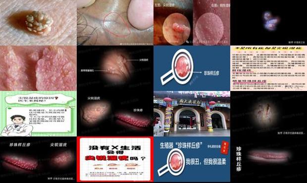 汕头下体长了很多小颗粒是尖锐