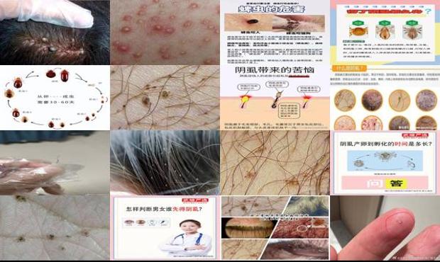 汕头怎么判断自己长了阴虱