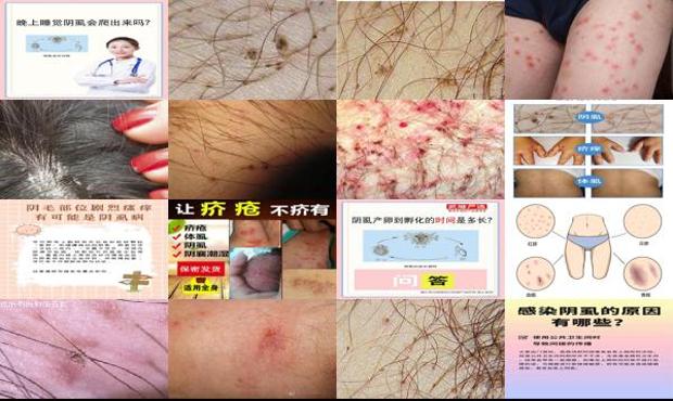 汕头长阴虱病是怎么引起的