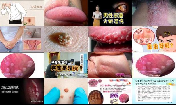 汕头男性尖锐湿疣能自愈吗