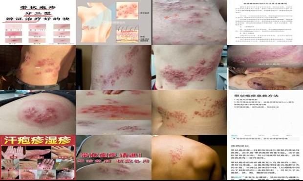汕头疱疹怎么治疗好得快
