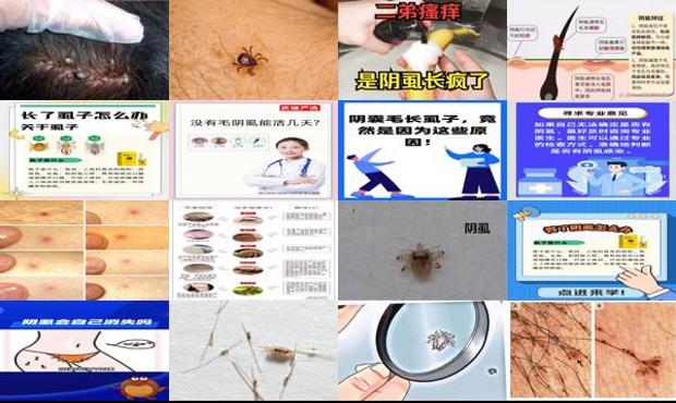 汕头怎么判断自己有阴虱