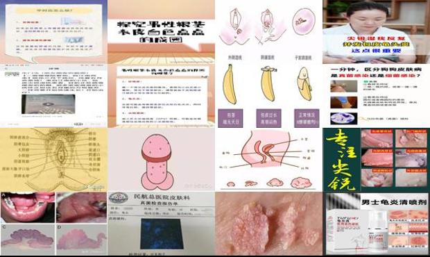 汕头包皮尖锐湿疣和龟头炎的区别