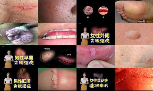汕头尖锐湿疣早期症状图片