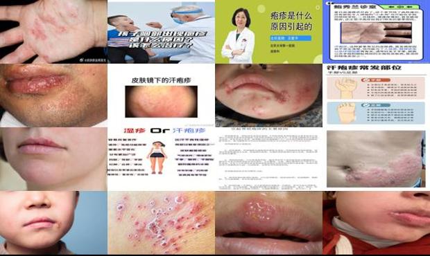 汕头疱疹是什么原因引起