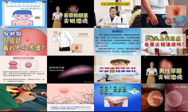 汕头龟头尖锐湿疣图片对照