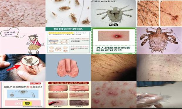 汕头阴虱子是怎么形成的男性