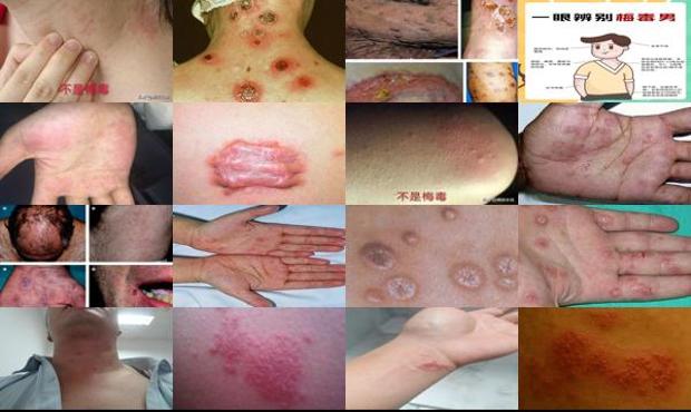 汕头男人患上梅毒是啥样