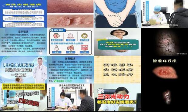 汕头男性尖锐湿疣一般感染多久才发现