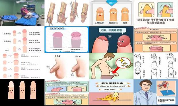 汕头男生正常包皮图片