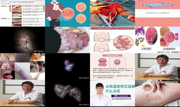 汕头艾滋病会有包皮尖锐湿疣图片
