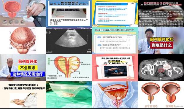 汕头前列腺增生并钙化症