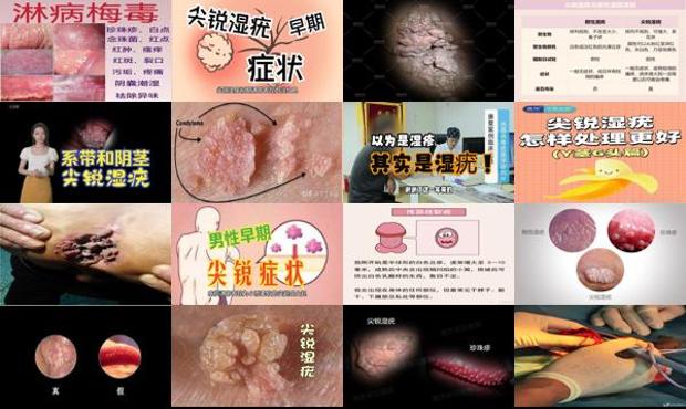 汕头龟头尖锐锐湿疣图片
