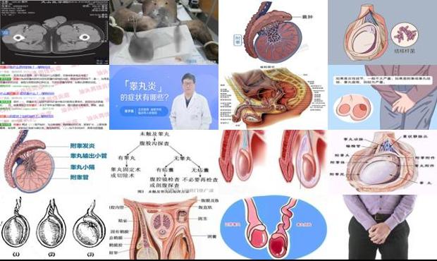 汕头睾丸炎症有什么症状