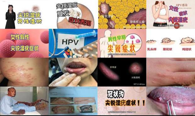 汕头尖锐湿疣什么症状