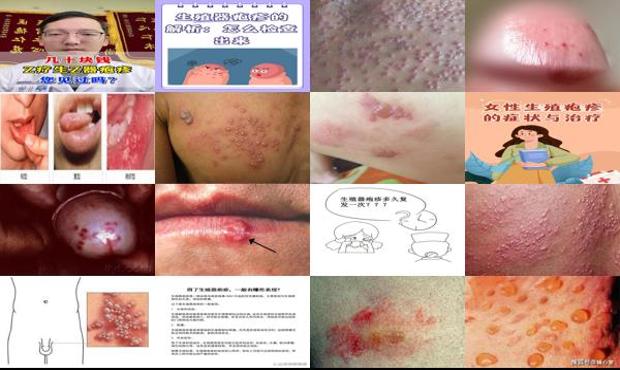汕头生殖疱疹症状图片大*
