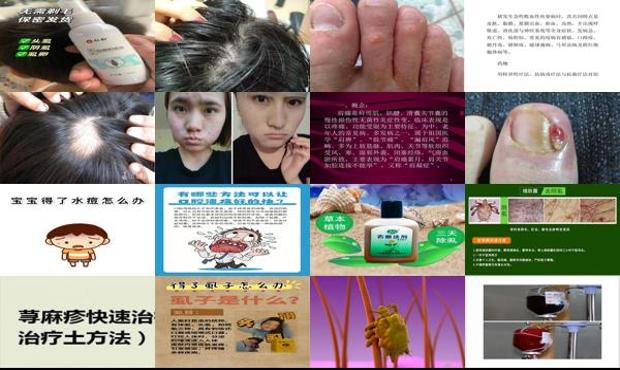 汕头治疗阴虱*快的方法