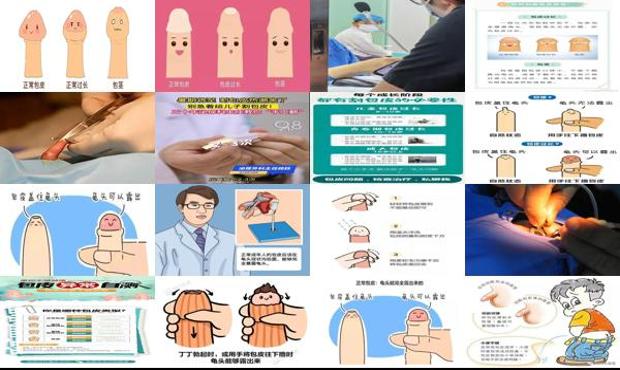 汕头7岁男孩包皮过长