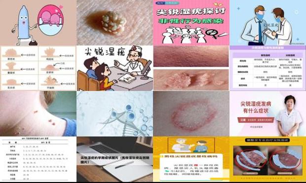 汕头性尖锐湿疣病什么原因男性