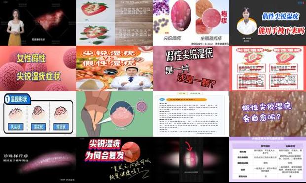 汕头假性尖锐湿疣怎么治疗