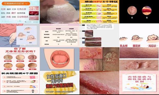 汕头长小肉粒*是尖锐湿疣么