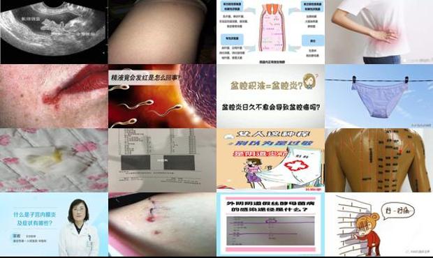 汕头下体流黄水是什么炎症