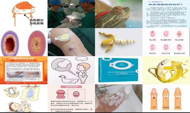 汕头包皮内有白色分泌物是怎么回事