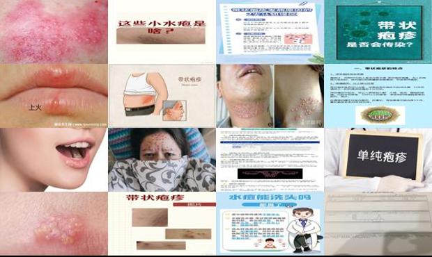 汕头疱疹*会传染别人吗