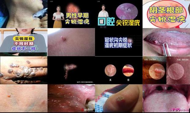 汕头尖锐湿疹初期症状图片