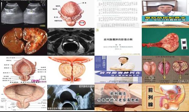 汕头前列腺*是什么病