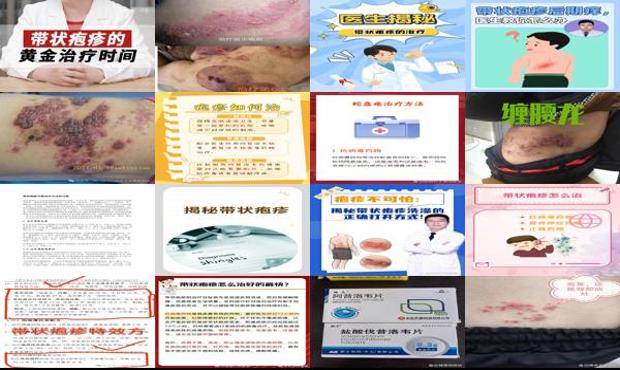 汕头带状疱疹*治疗方法
